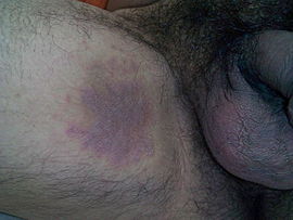 270px-Tinea_cruris.jpg